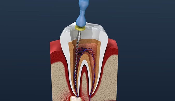 Root Canal Therapy